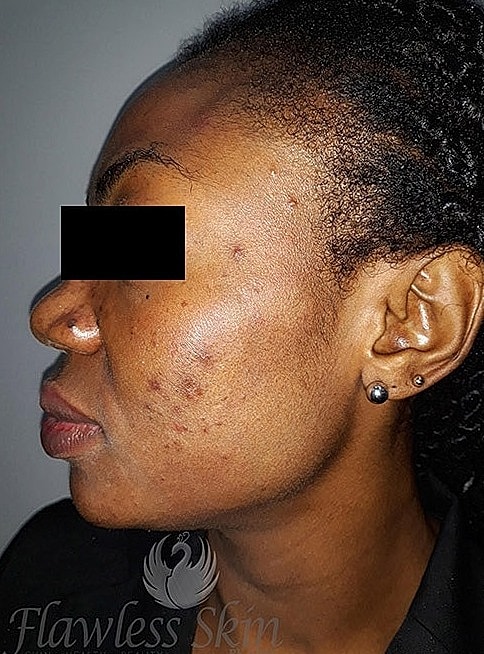 Microneedling With Prp Before & After