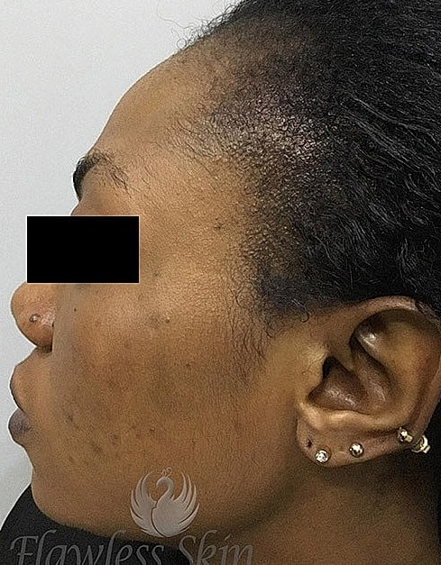 Microneedling With Prp Before & After