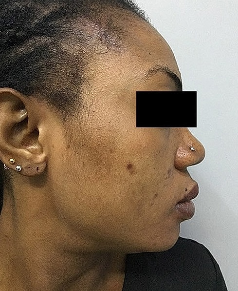 Microneedling With Prp Before & After