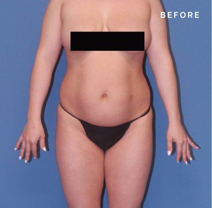 Before body transformation photo, front view.