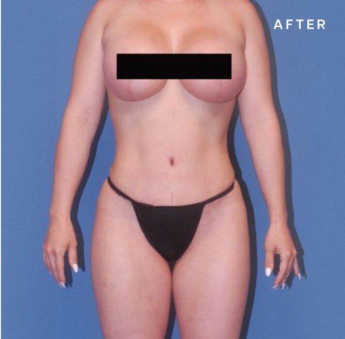 Body transformation results after cosmetic procedure.