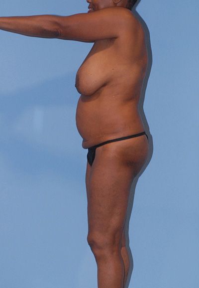 Breast Reduction And Lift Before & After
