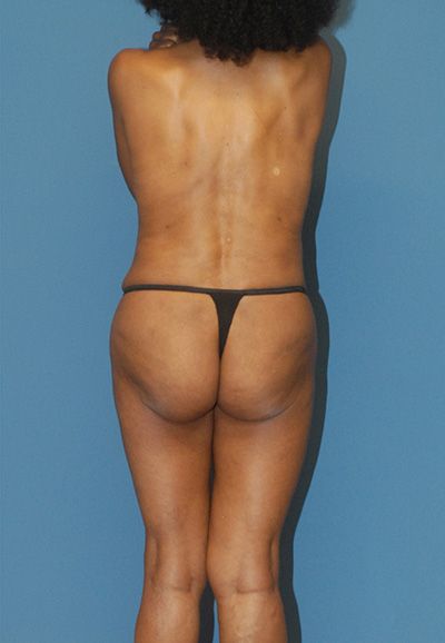 Breast Reduction And Lift Before & After