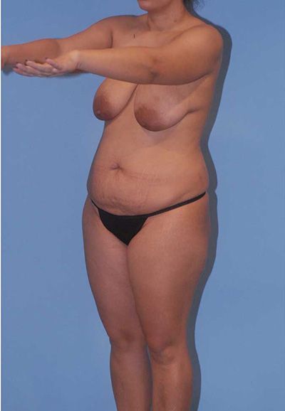 Breast Reduction And Lift Before & After