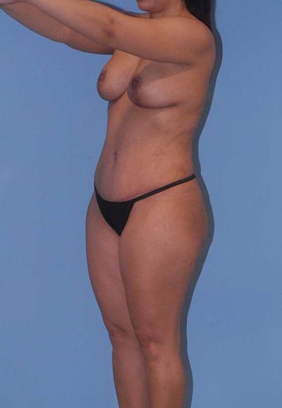 Breast Reduction And Lift Before & After