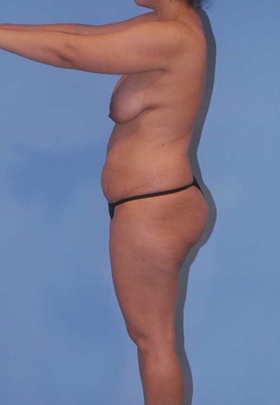 Breast Reduction And Lift Before & After