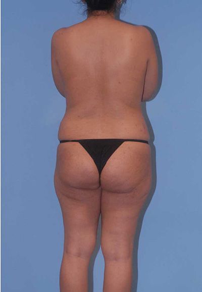 Breast Reduction And Lift Before & After