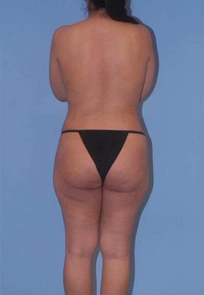 Breast Reduction And Lift Before & After