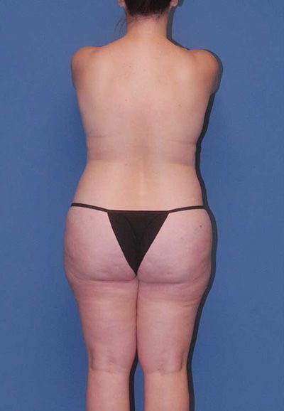 Breast Reduction And Lift Before & After