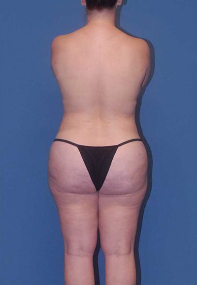 Breast Reduction And Lift Before & After