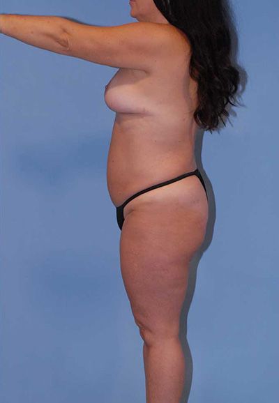 Breast Reduction And Lift Before & After