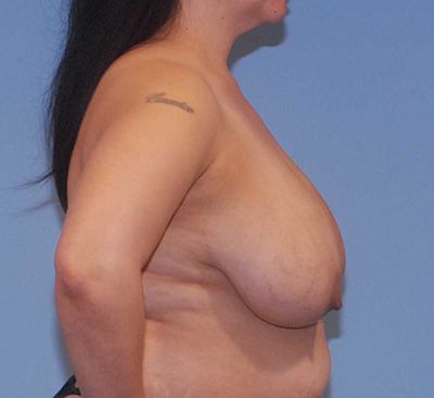 Breast Reduction And Lift Before & After
