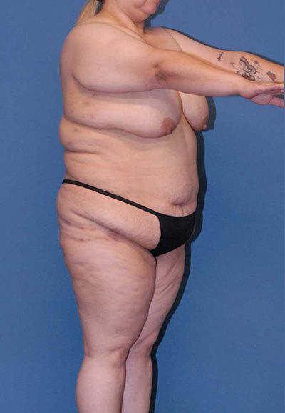 Breast Reduction And Lift Before & After