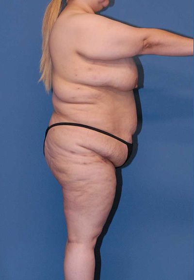 Breast Reduction And Lift Before & After