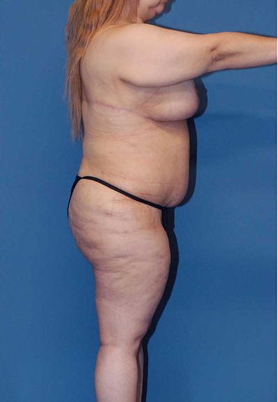 Breast Reduction And Lift Before & After