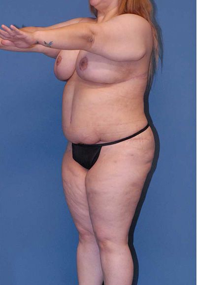 Breast Reduction And Lift Before & After