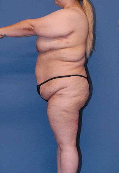 Breast Reduction And Lift Before & After