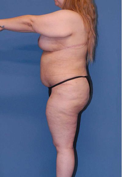 Breast Reduction And Lift Before & After