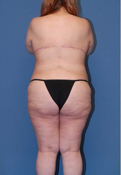 Breast Reduction And Lift Before & After
