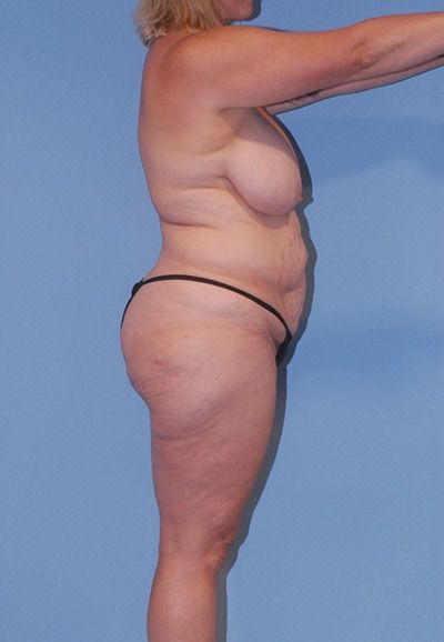 Abdominoplasty Before & After