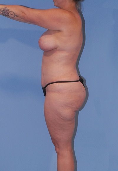 Abdominoplasty Before & After