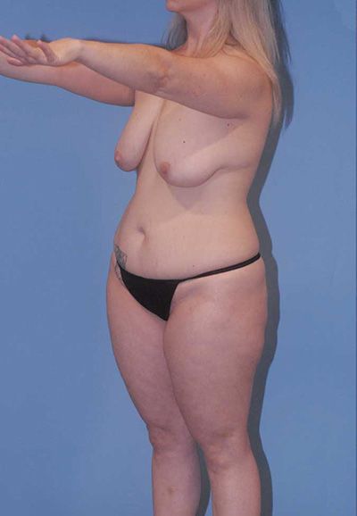 Abdominoplasty Before & After