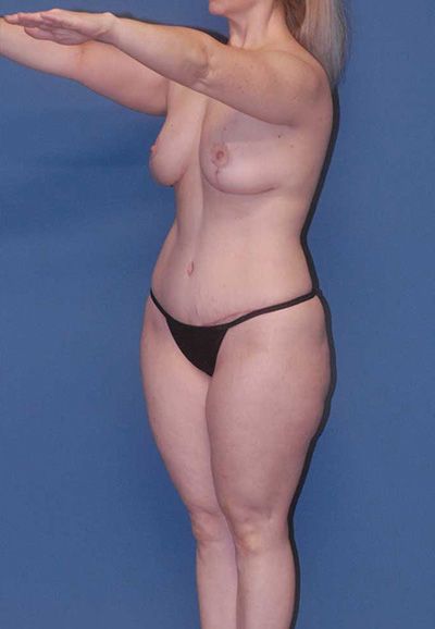 Abdominoplasty Before & After