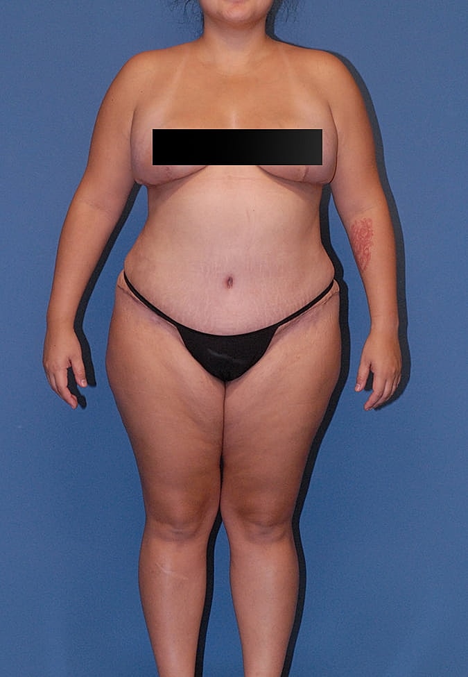 Abdominoplasty Before & After