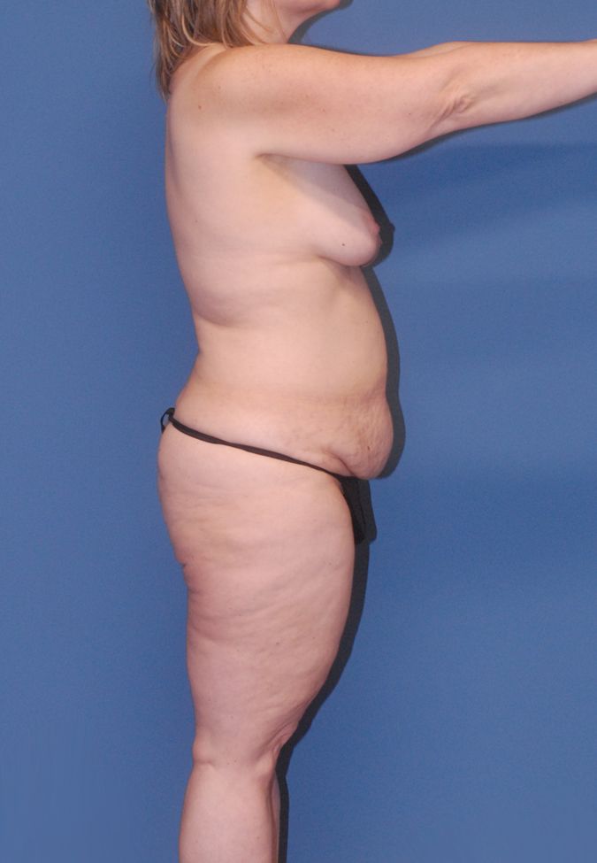 Abdominoplasty Before & After