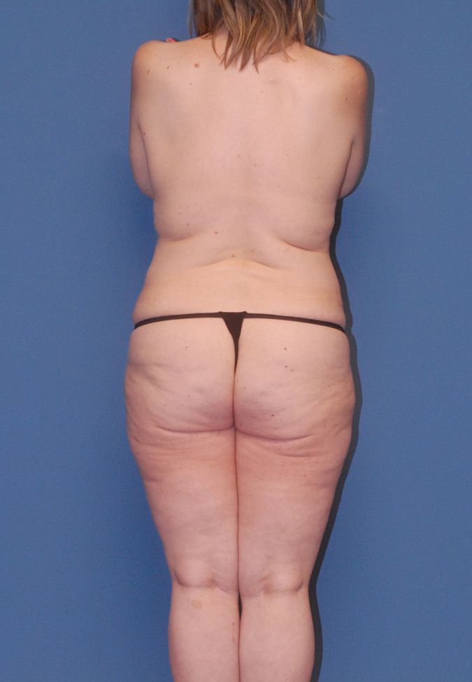 Abdominoplasty Before & After