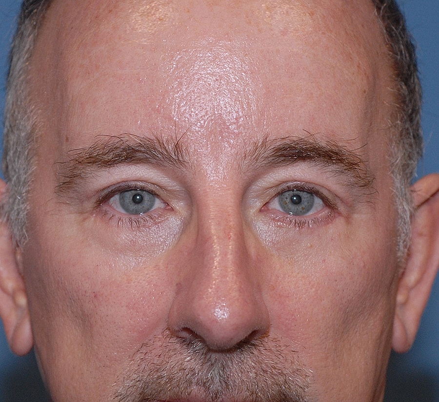 Brow Lift Before & After