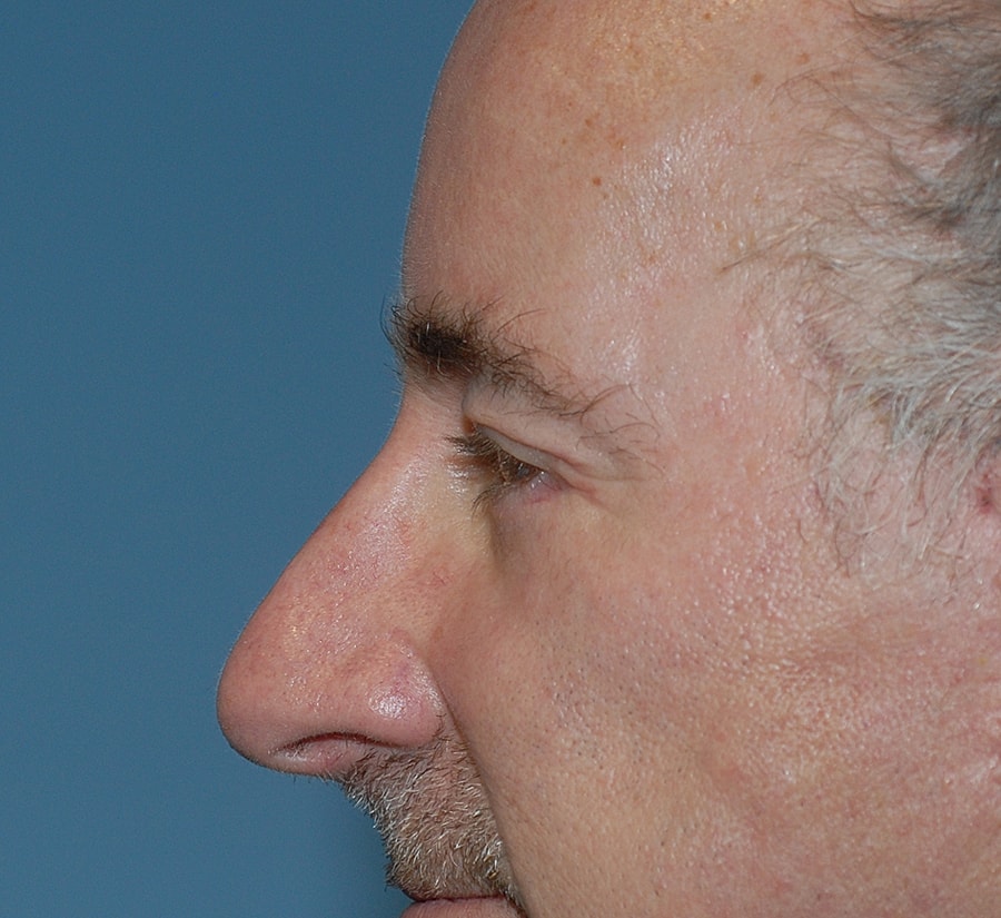 Brow Lift Before & After