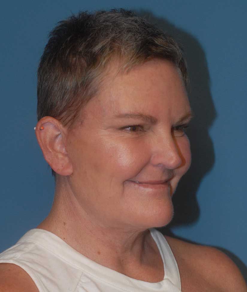 Facelift Before & After
