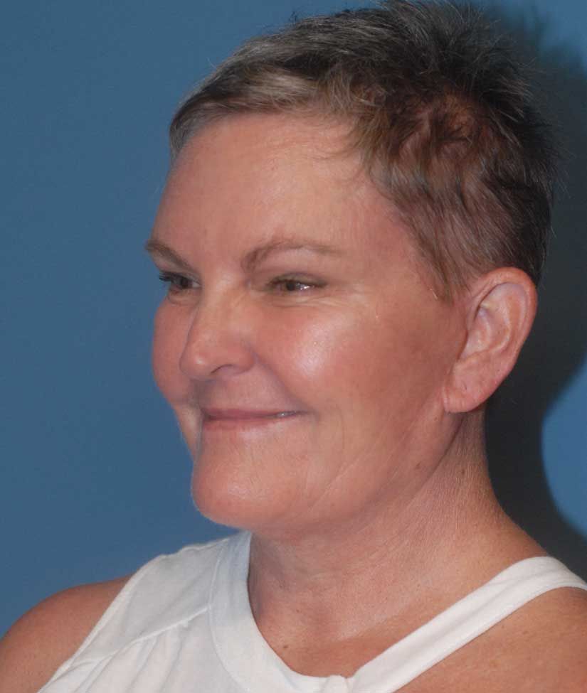 Facelift Before & After