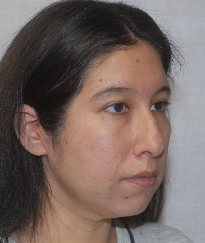 Rhinoplasty Before & After