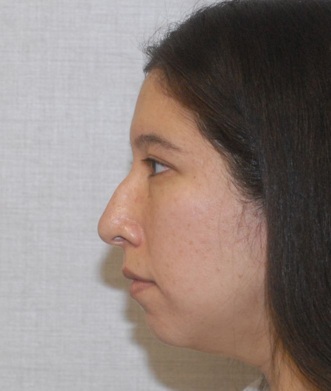 Rhinoplasty Before & After
