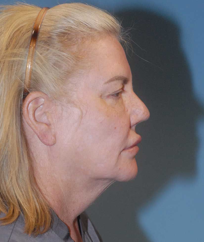 Rhinoplasty Before & After