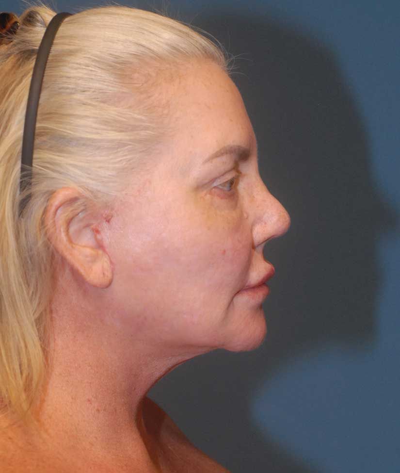 Rhinoplasty Before & After