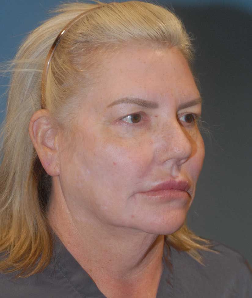 Rhinoplasty Before & After