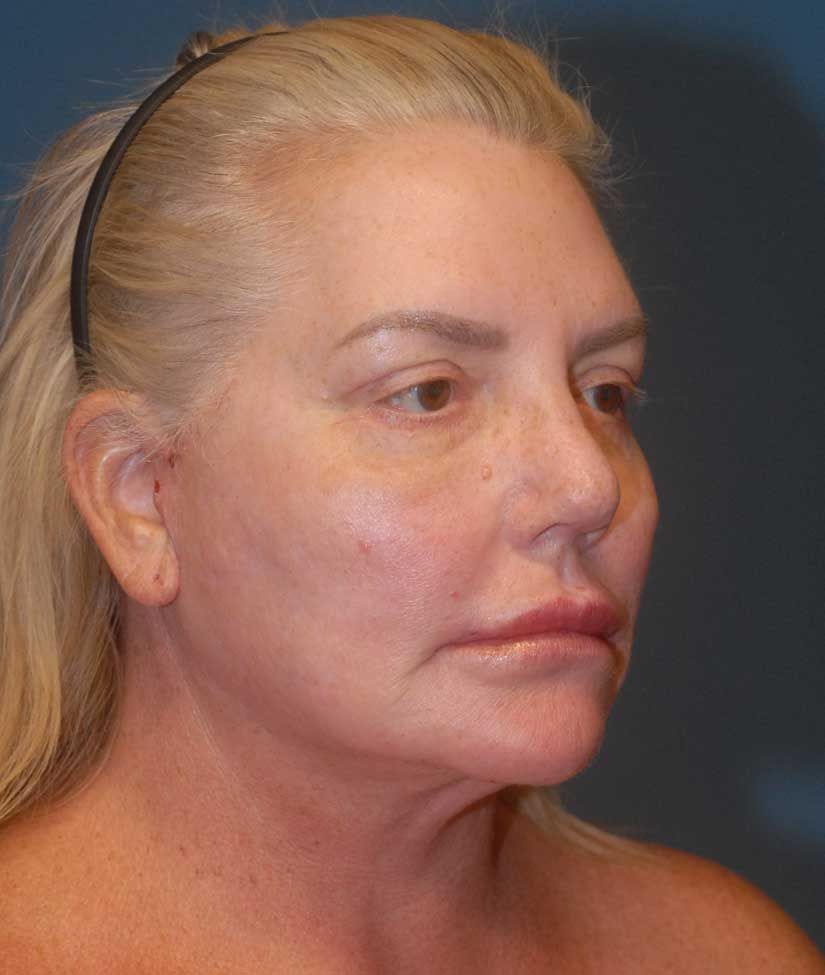 Rhinoplasty Before & After