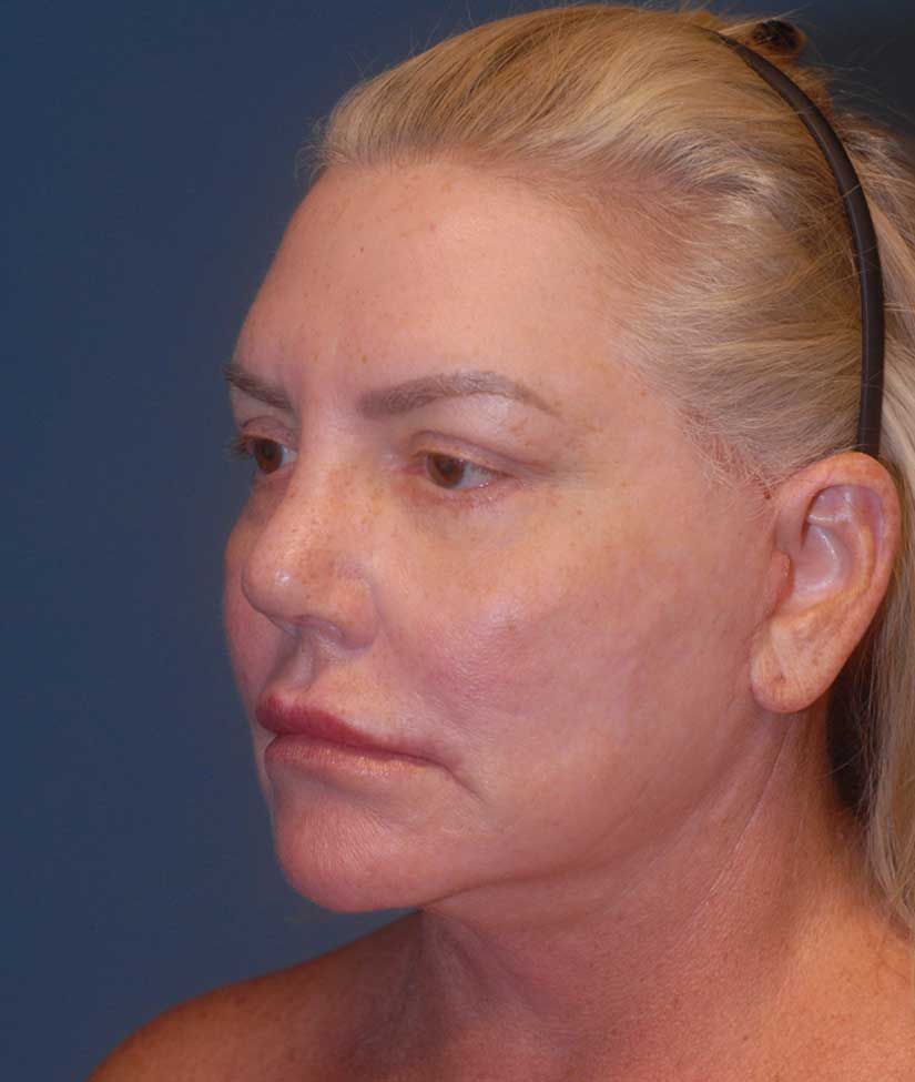 Rhinoplasty Before & After