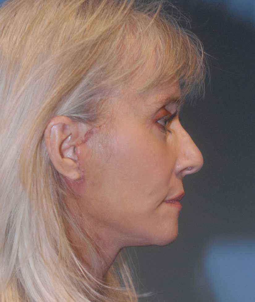 Neck Lift Before & After