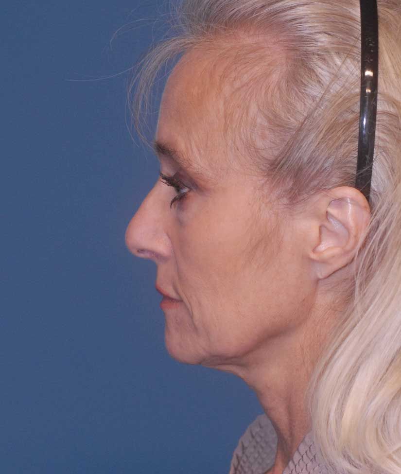 Neck Lift Before & After
