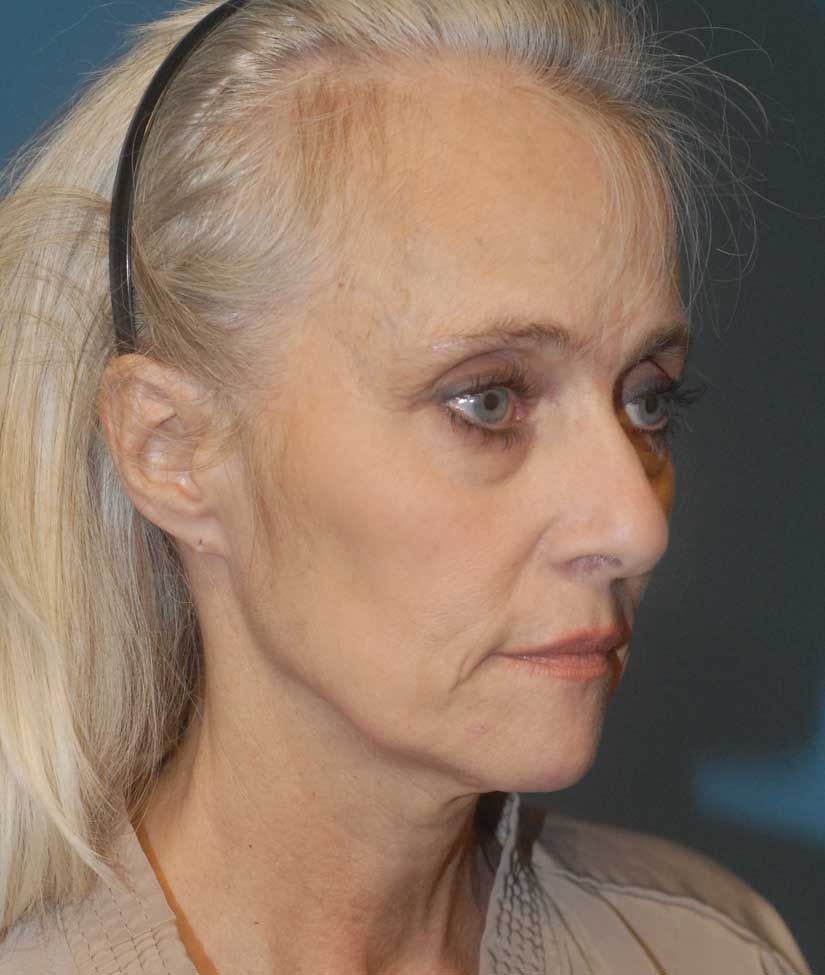 Neck Lift Before & After