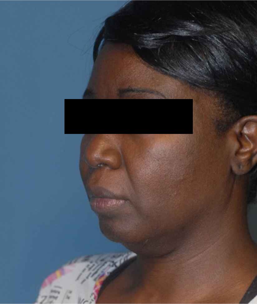 Neck Lift Before & After