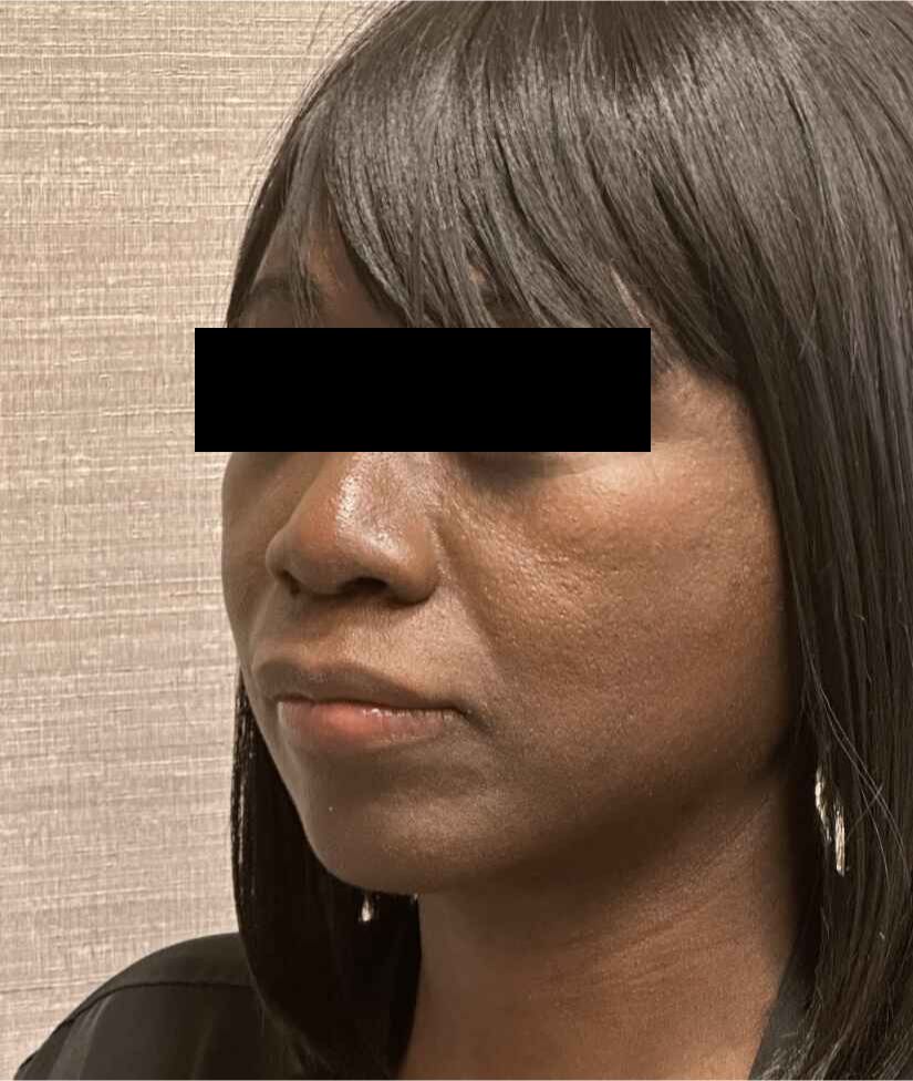 Neck Lift Before & After
