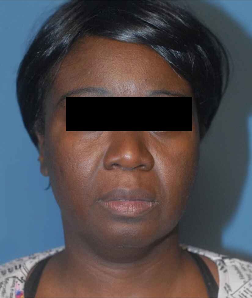Neck Lift Before & After