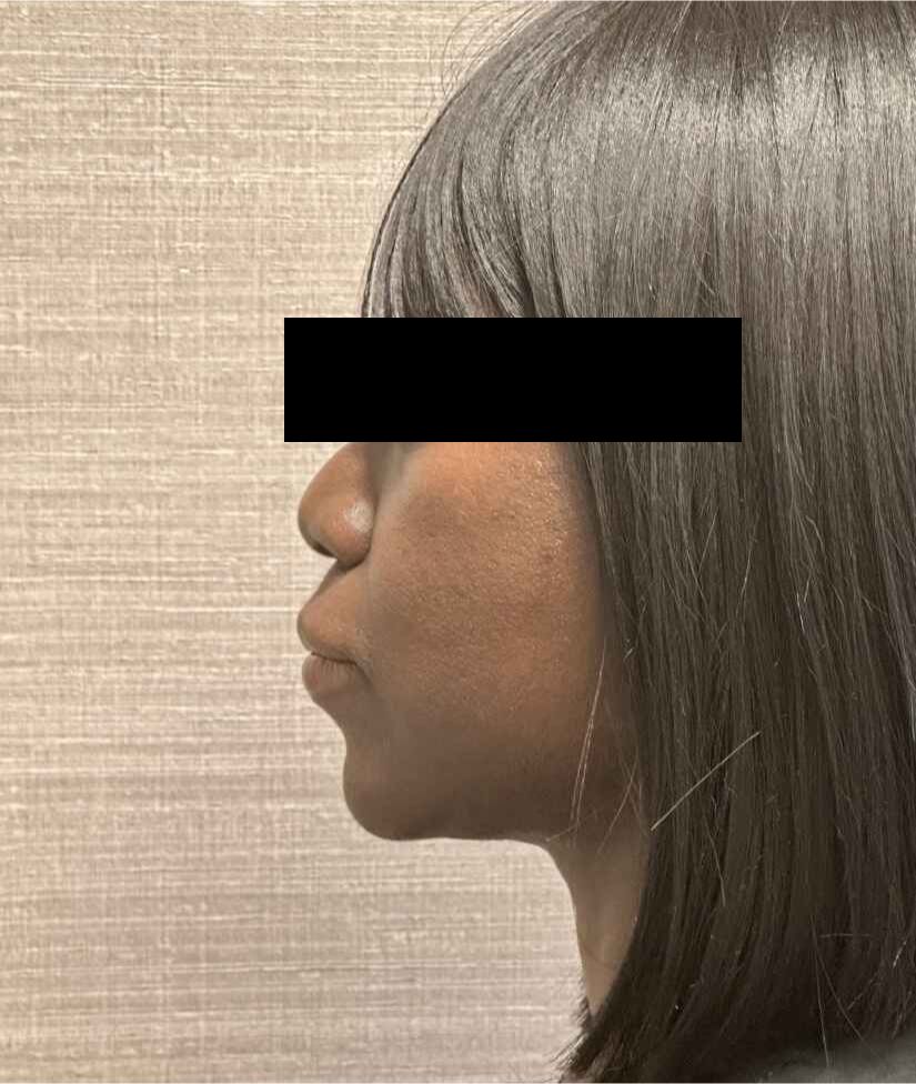 Neck Lift Before & After