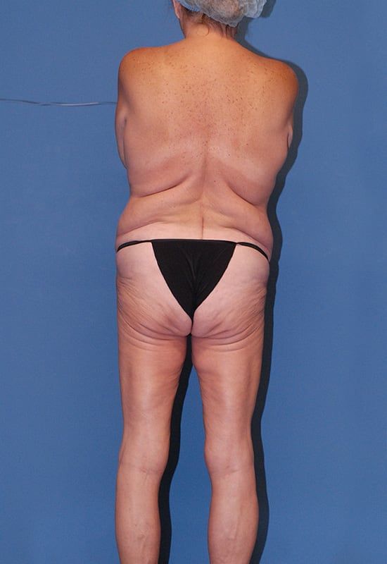 Torsoplasty Before & After