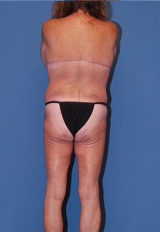 Torsoplasty Before & After